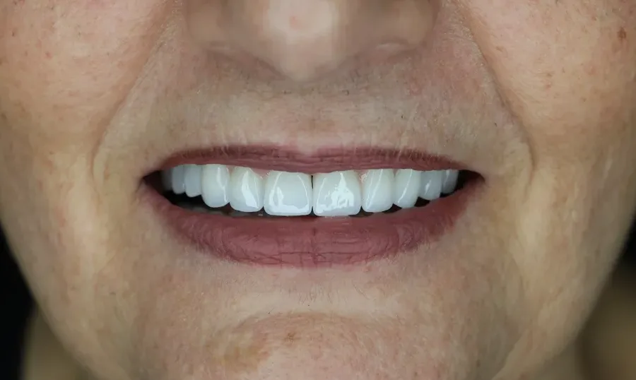 L'arcata superiore ricostruita con impianti dentali e corone