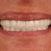 Gli stessi denti dopo un impianto e 24 corone in zirconia