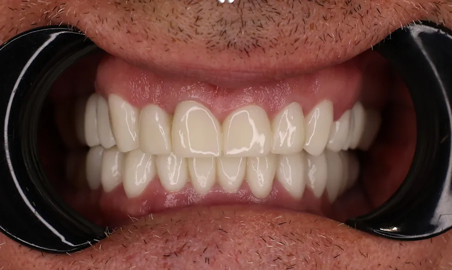 Gli stessi denti dopo le corone in ceramica