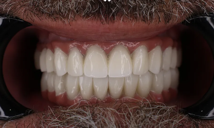 Gli stessi denti dopo le faccette in ceramica