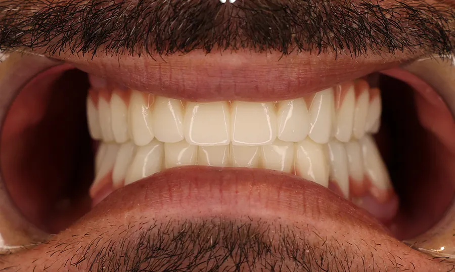 Gli stessi denti dopo la riabilitazione protesica completa